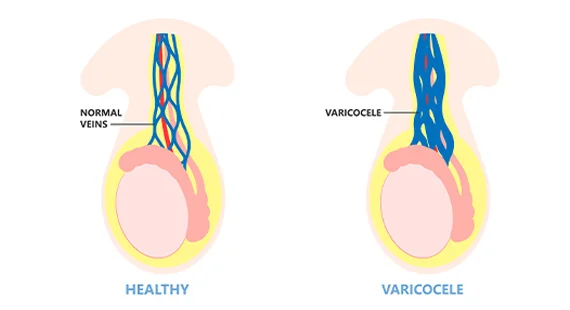 what is varicocele